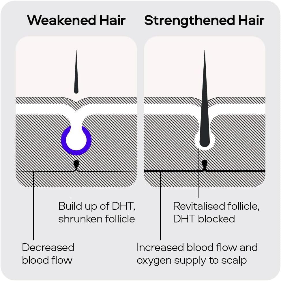 Sons Minoxidil 5% Solution & Hair Growth Shampoo for Men. Hair Regrowth Treatmen...
