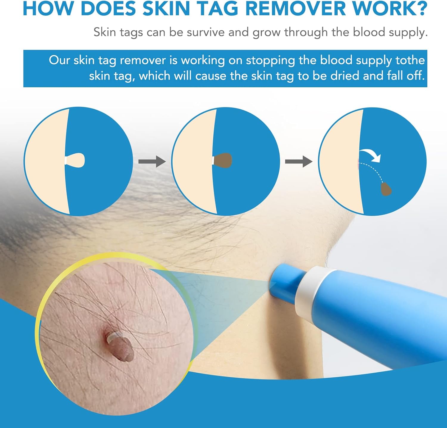 Auto Skin Tag Remover Kit for Face & Body, Upgraded Fast and Easy Removal Pen fo...