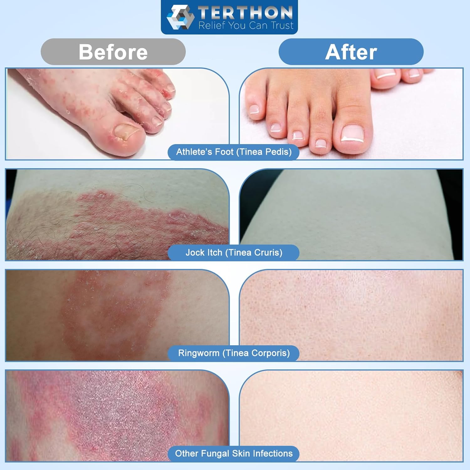 Herbal Antifungal Cream: Treatment for Ringworm, Jock Itch, Athlete’s Foot & Fun...