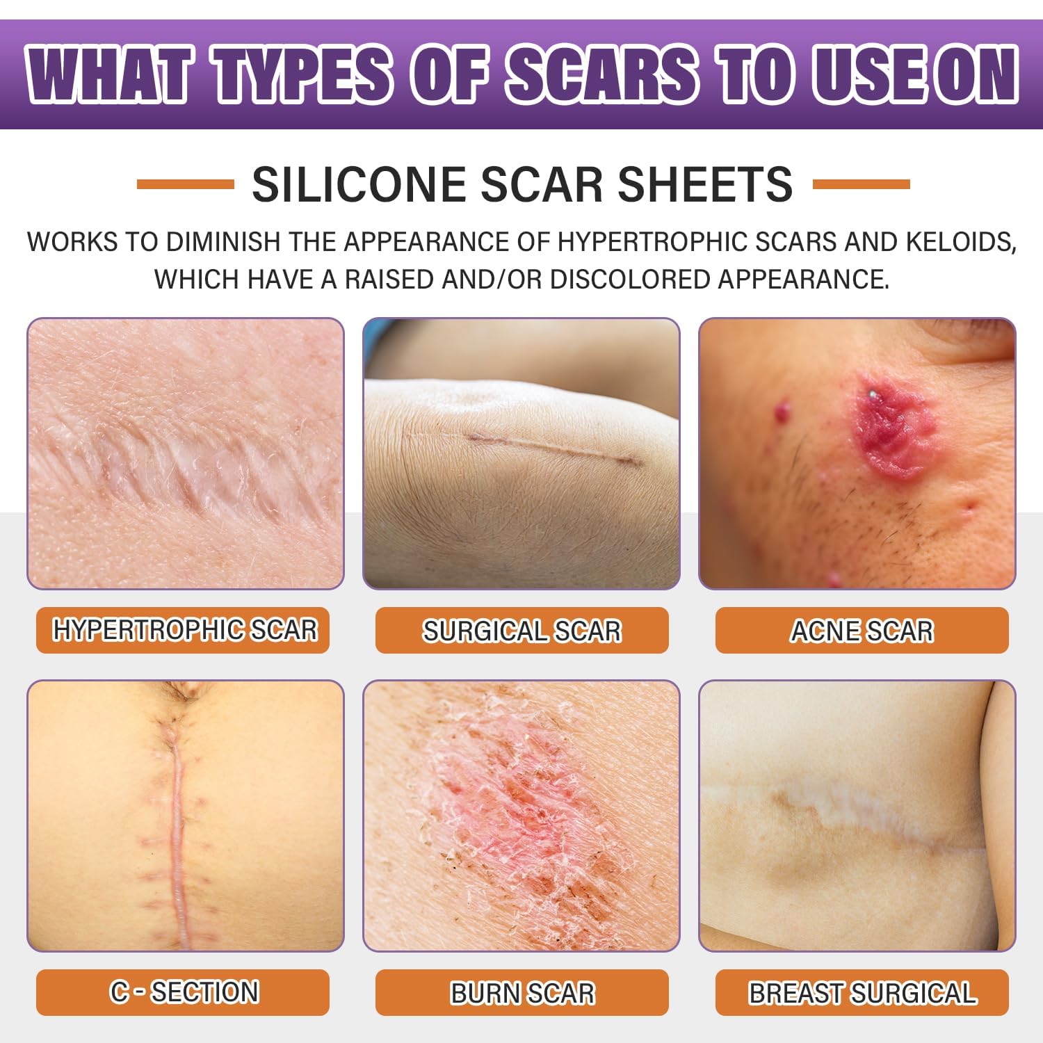 Silicone Scar Sheets,Silicone Scar Tape,Silicone Scar Removal Strips for Surgica...