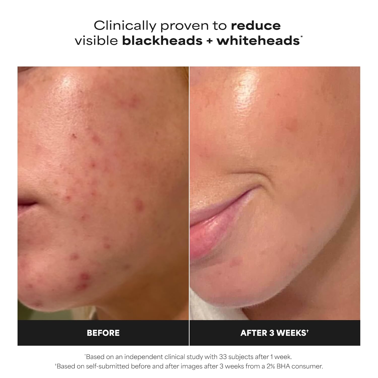 Paula's Choice SKIN PERFECTING 2% BHA Liquid Exfoliant with Salicylic Acid, Faci...